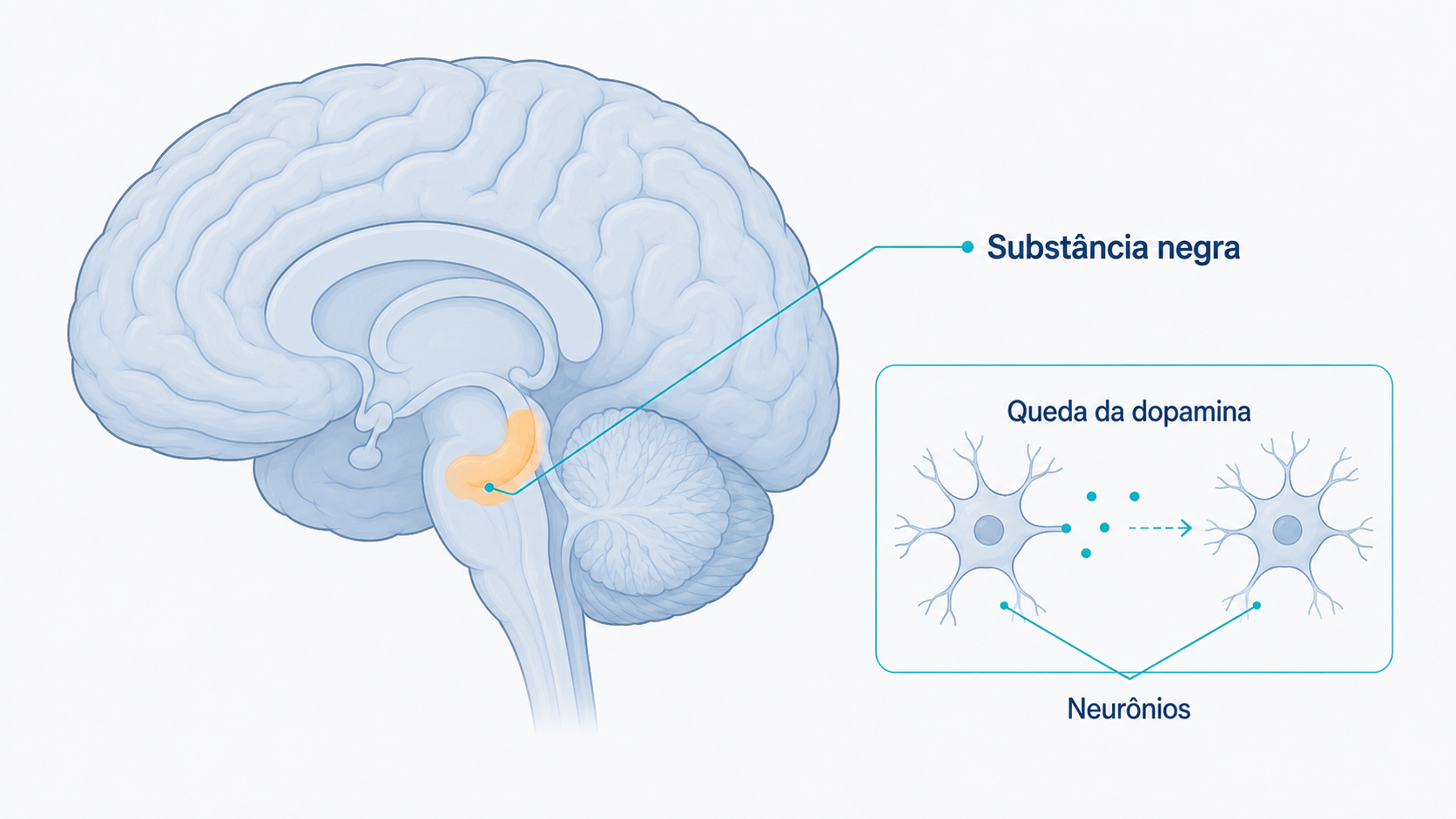 Ilustração do cérebro destacando a substância negra e a queda da dopamina.