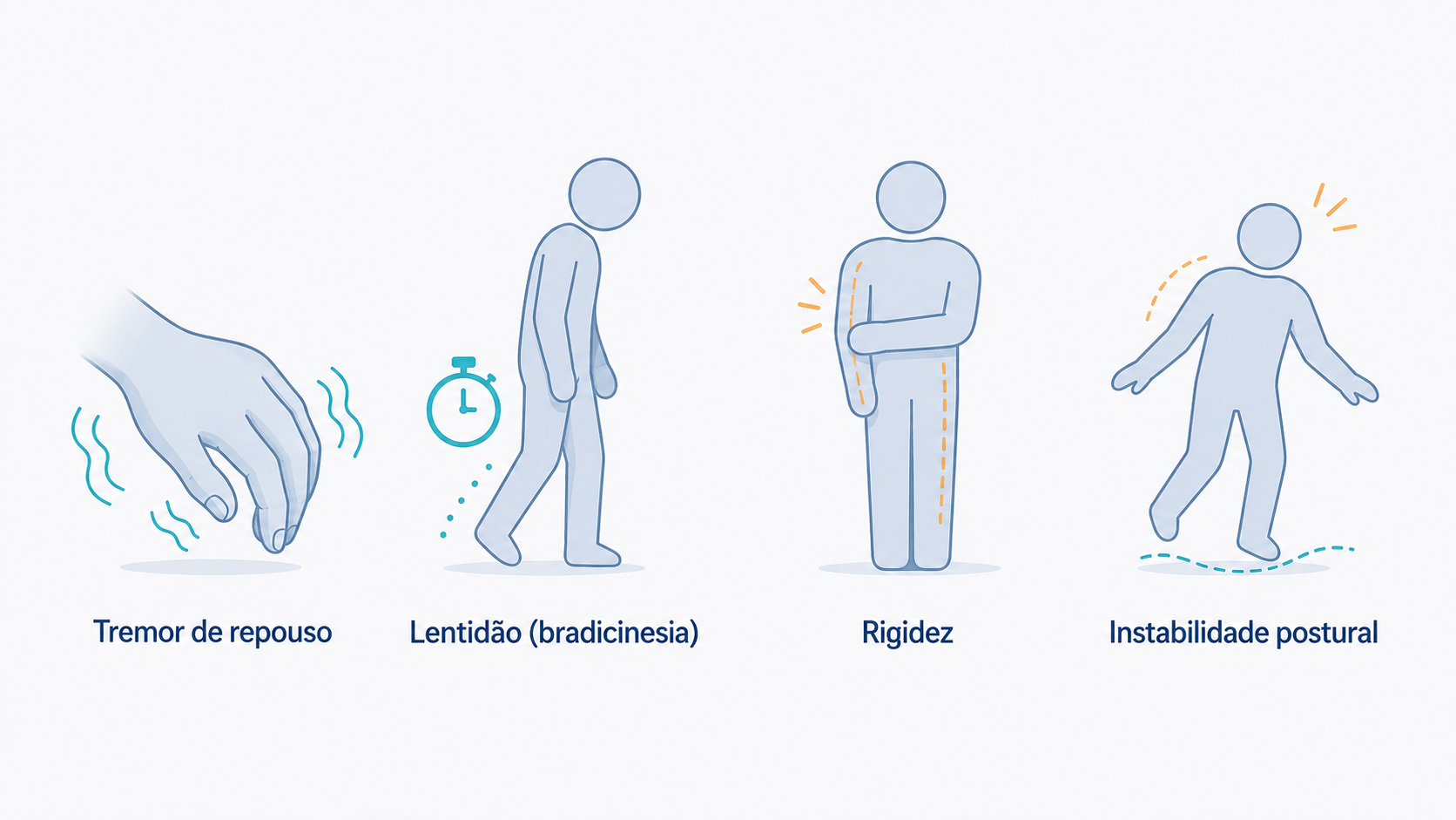 Ilustração dos quatro sinais motores do Parkinson.
