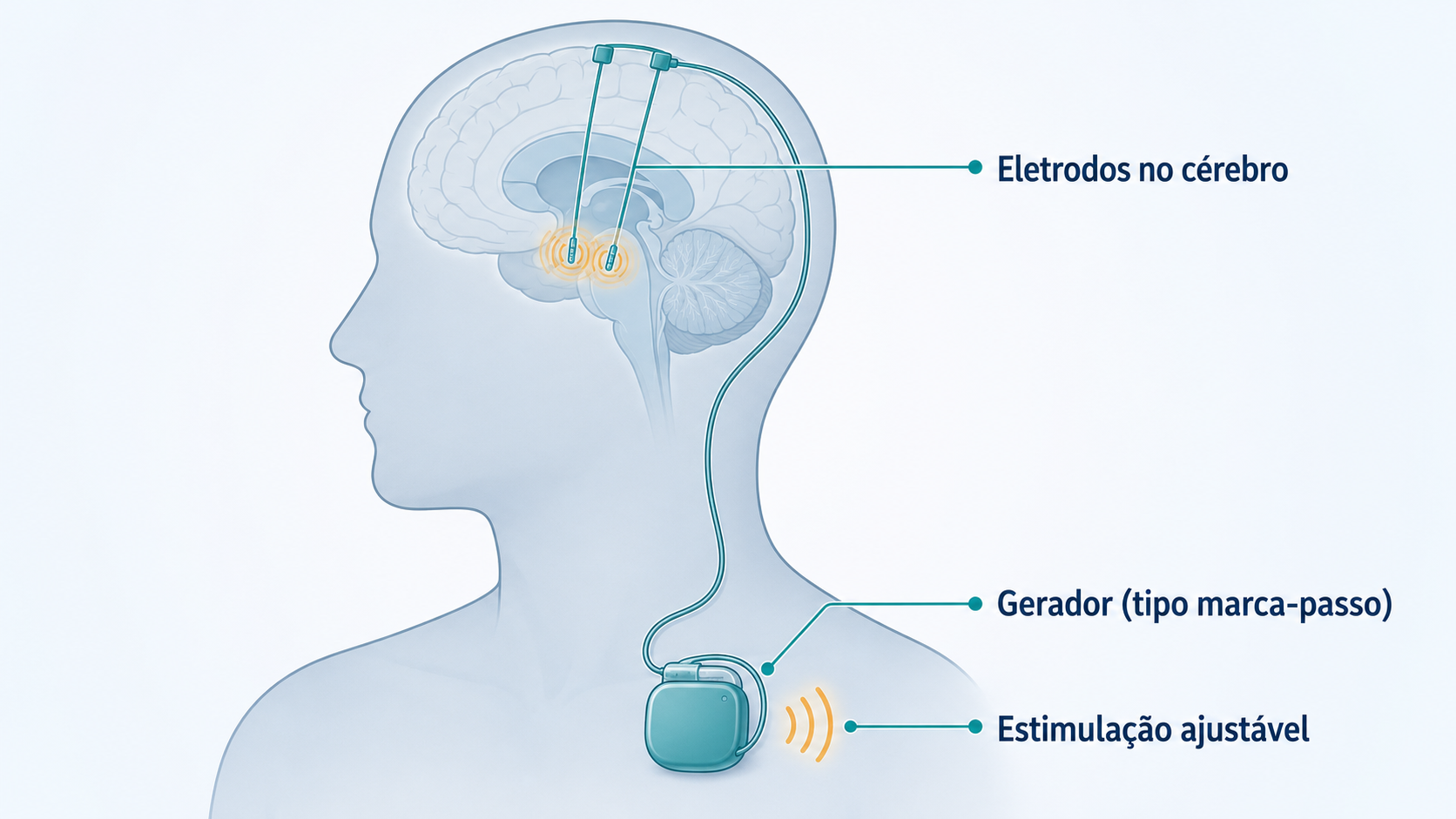 Esquema do sistema de estimulação cerebral profunda (DBS) para Parkinson.