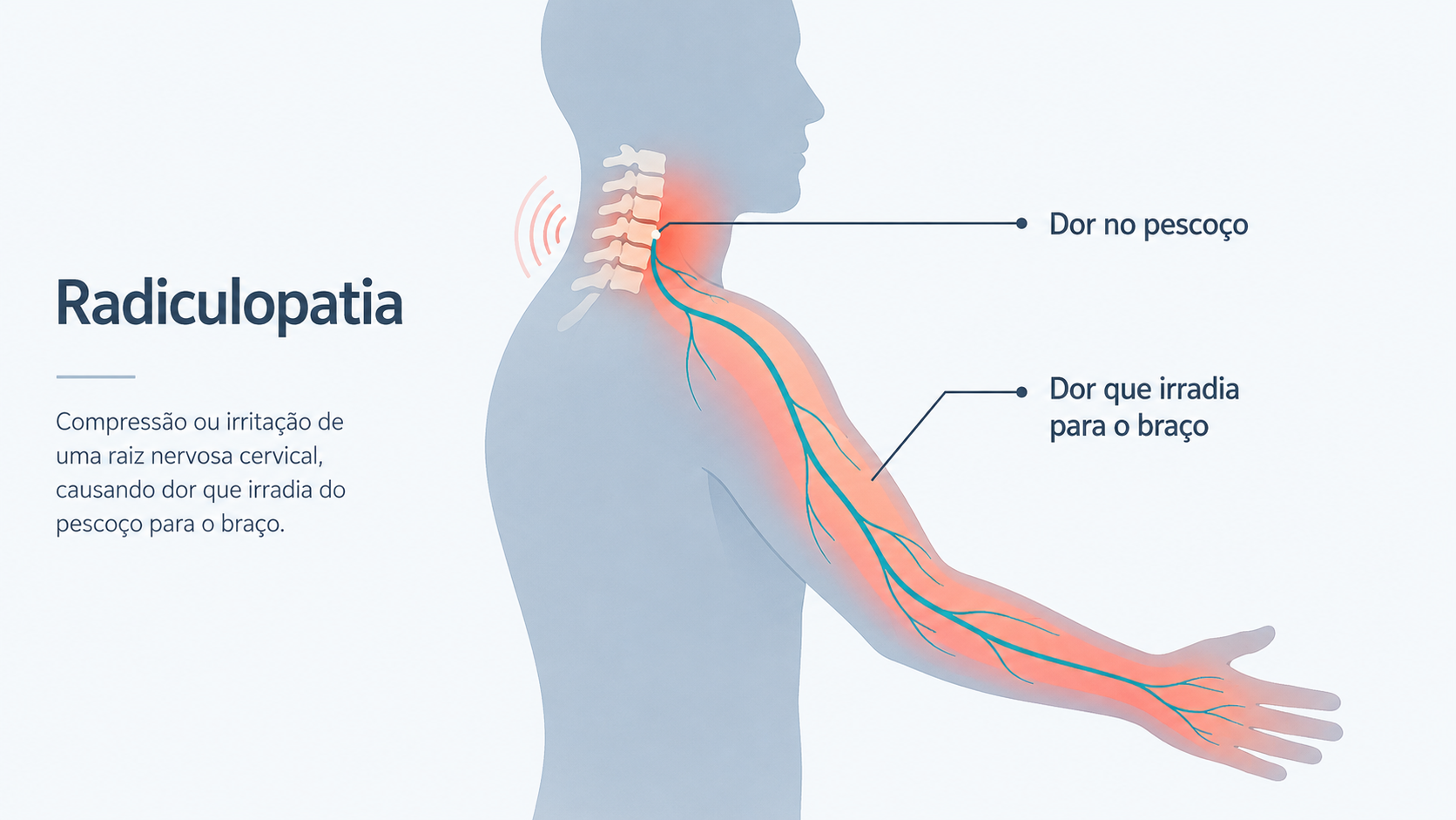 Ilustração de dor cervical irradiando para o braço por compressão de uma raiz nervosa.