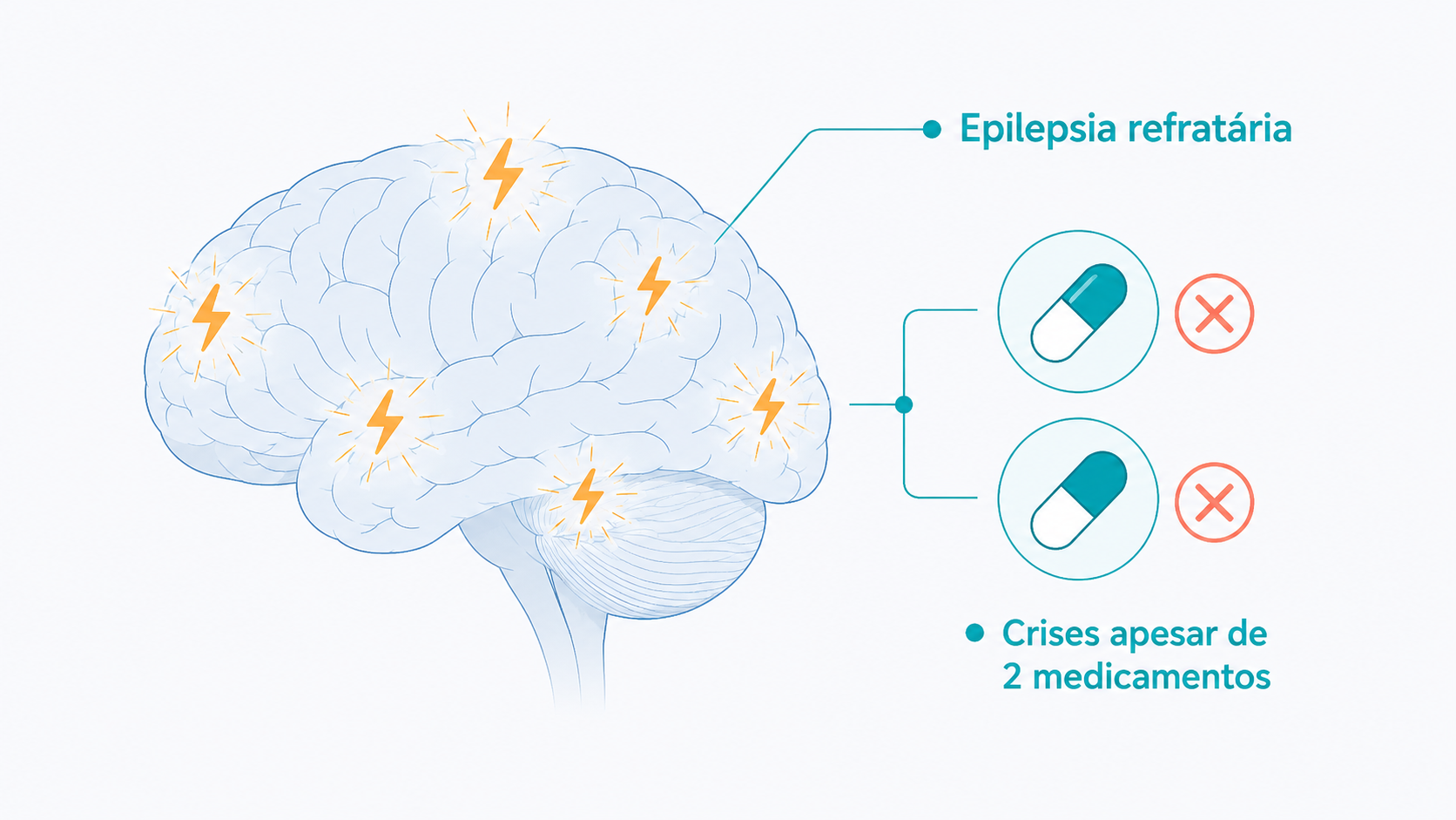 Ilustração de epilepsia refratária: as crises persistem apesar de dois medicamentos.
