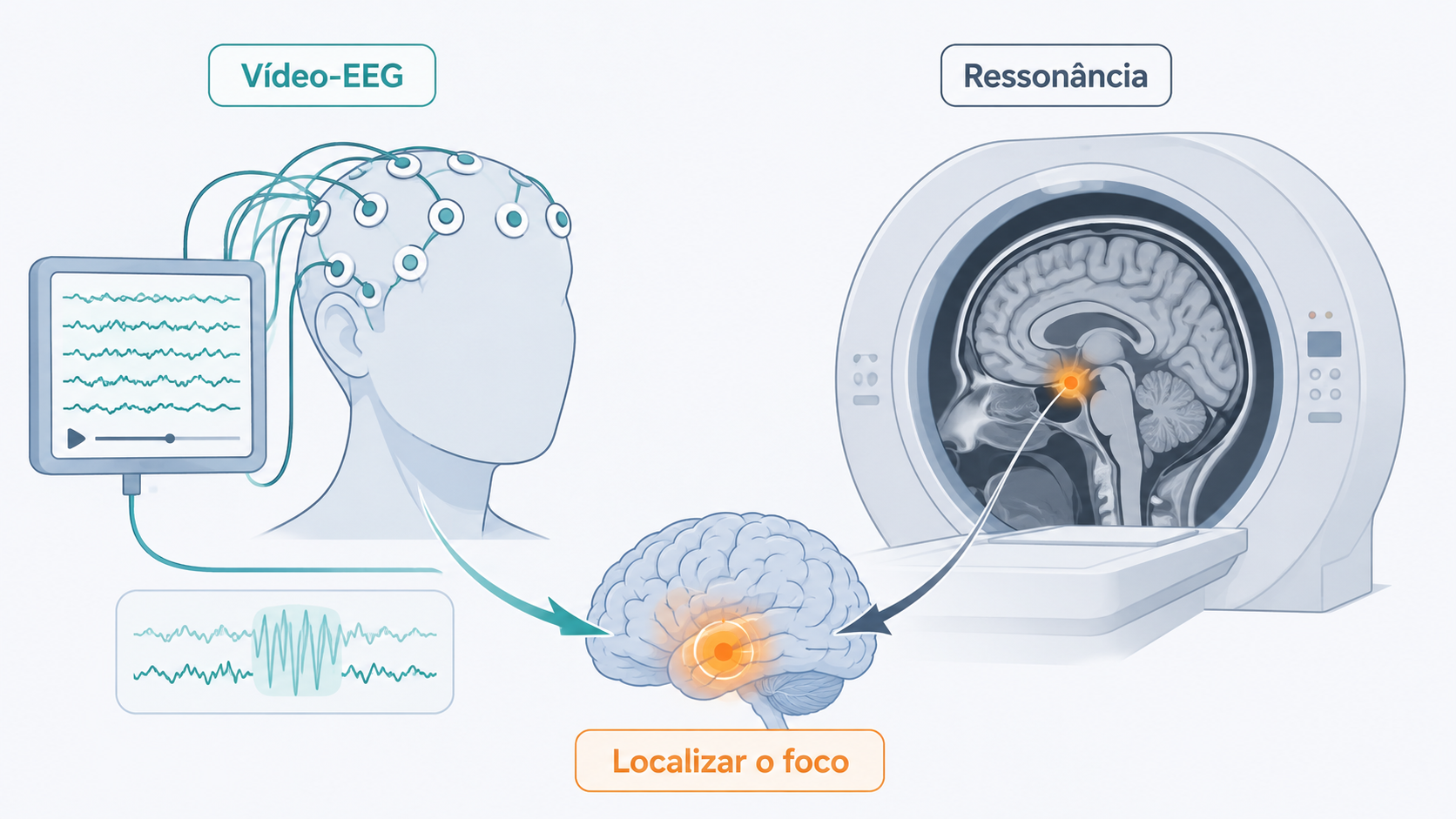 Ilustração da avaliação pré-cirúrgica da epilepsia com vídeo-EEG e ressonância para localizar o foco.