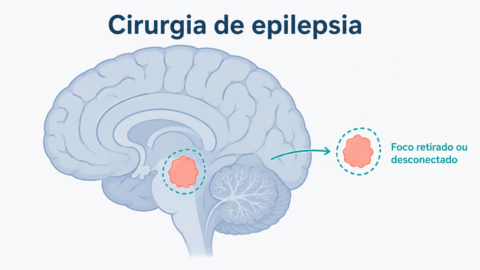 Esquema de cirurgia de epilepsia com retirada ou desconexão do foco epiléptico.