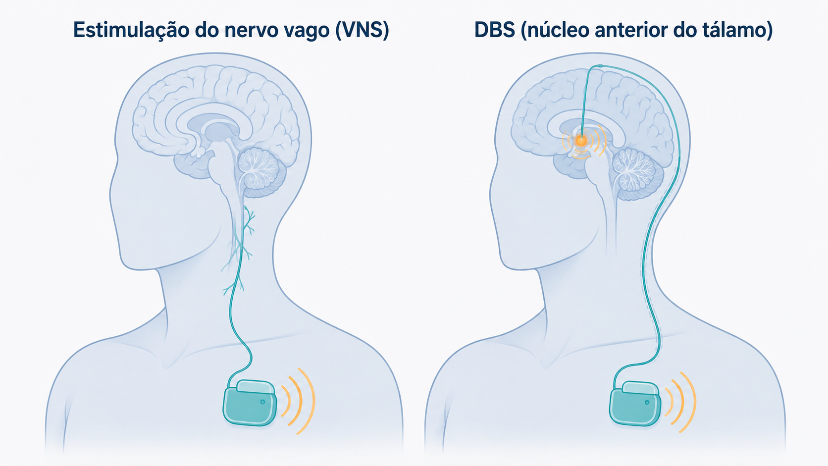 Esquema de neuromodulação na epilepsia: estimulação do nervo vago (VNS) e DBS do núcleo anterior do tálamo.