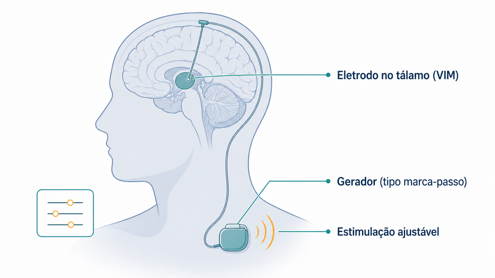 Esquema de estimulação cerebral profunda do tálamo (núcleo VIM) para o tremor essencial refratário.