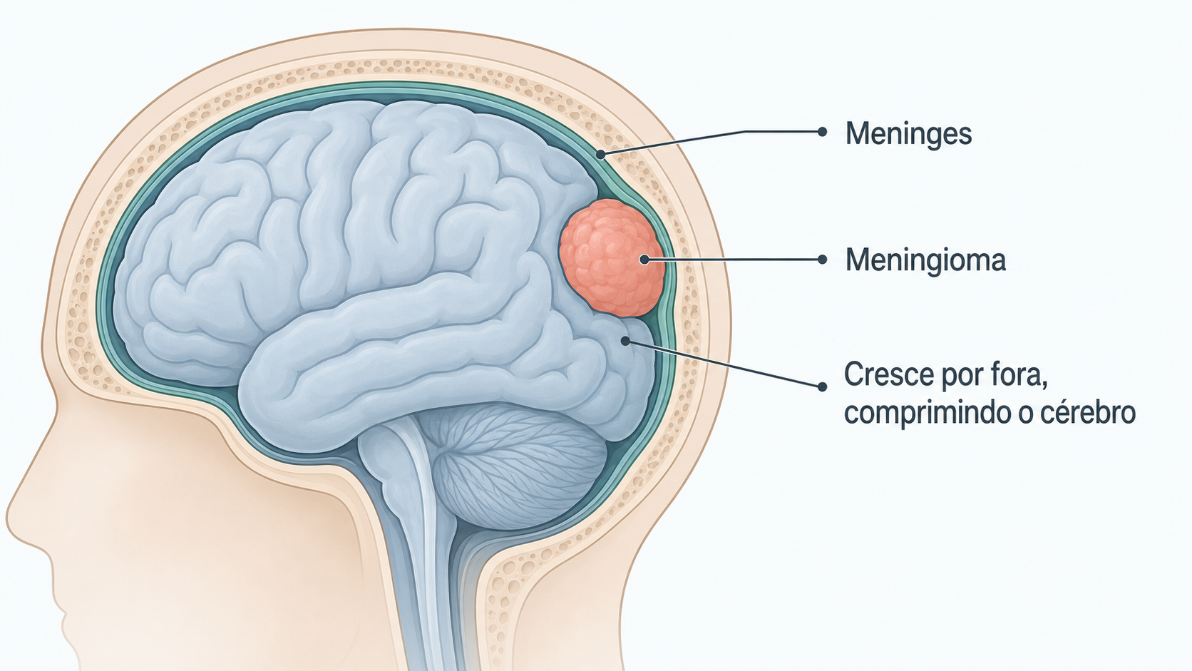 Ilustração de um meningioma originado nas meninges.