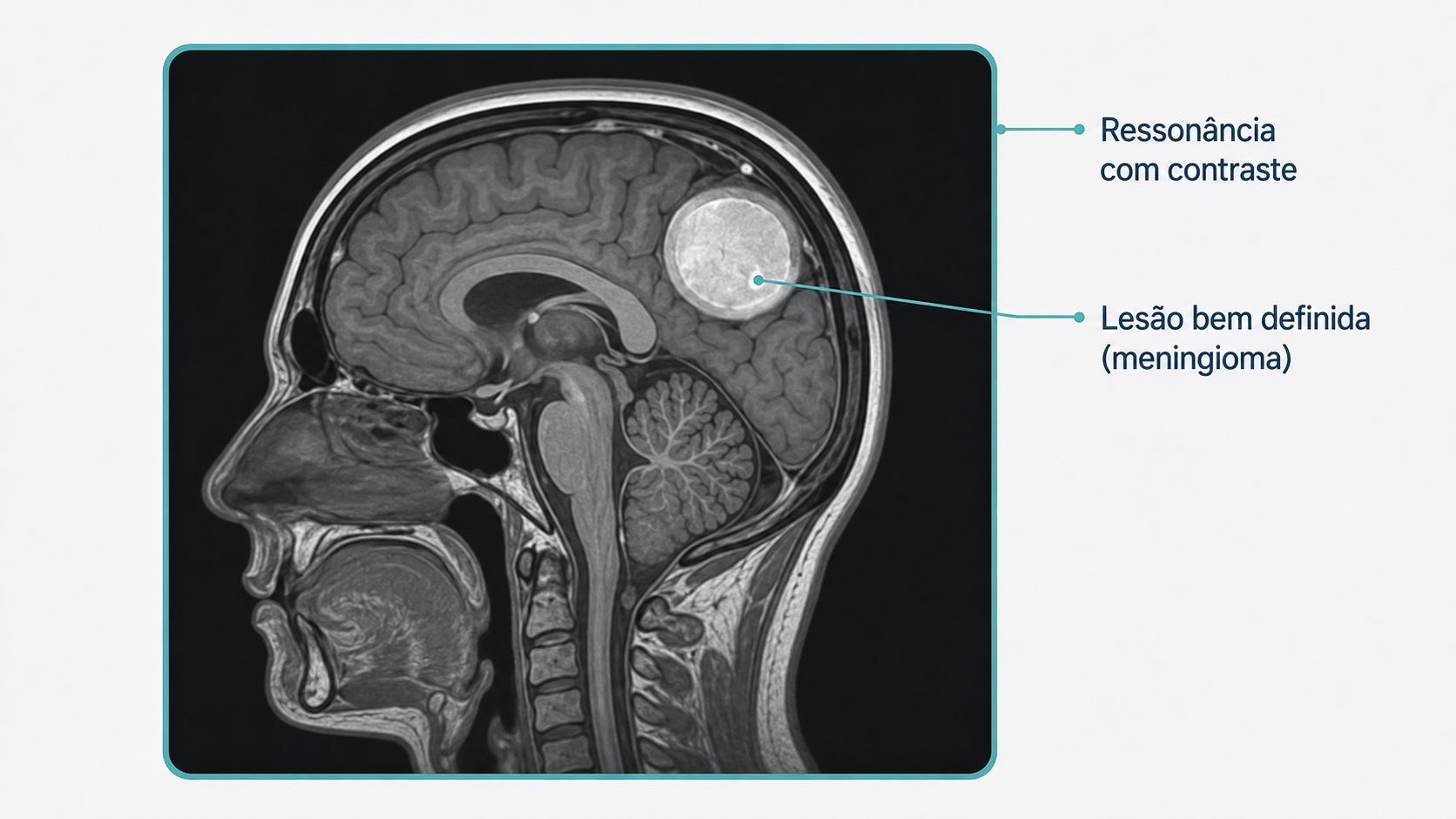Ilustração de ressonância com contraste evidenciando um meningioma.