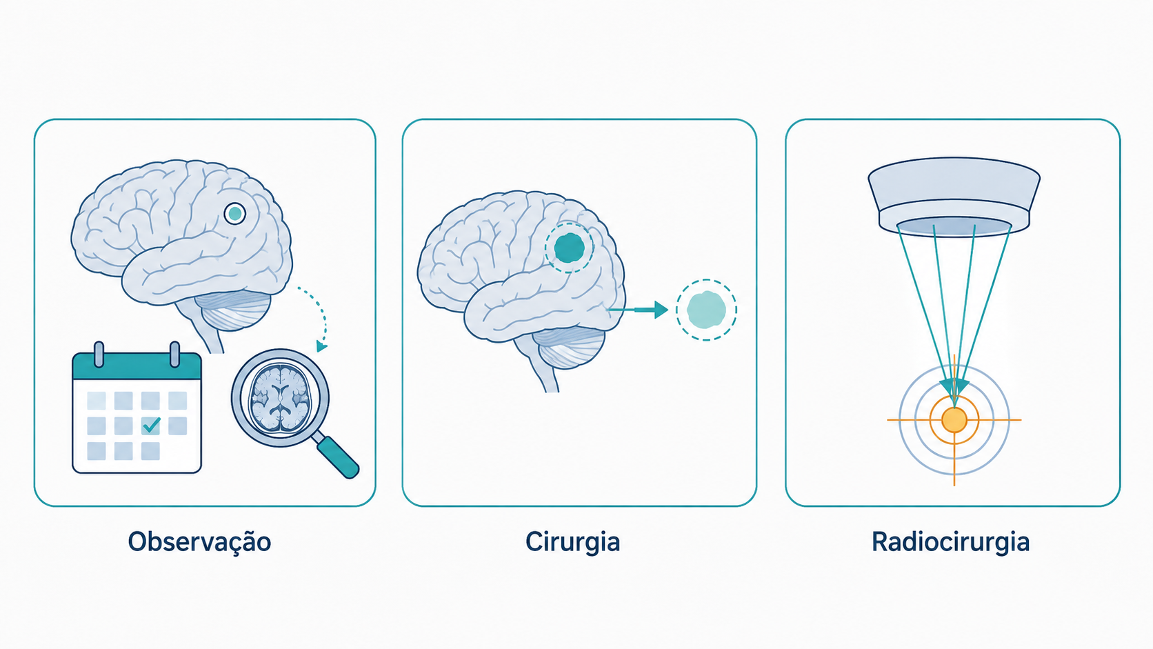 Ilustração das três opções de tratamento do meningioma.