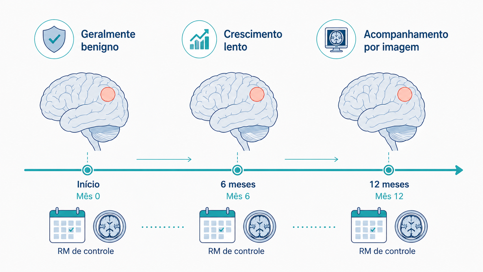 Ilustração de um meningioma benigno e de crescimento lento acompanhado por imagem.